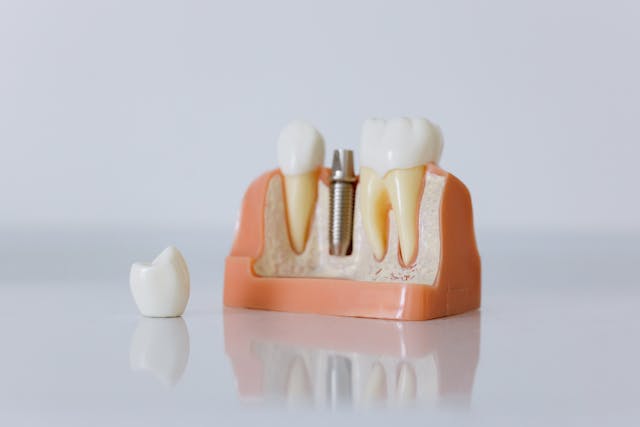 What Factors Impact The Cost Of Dental Implants In The UK?
